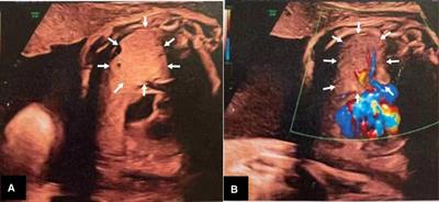 A case report of misdiagnosed fetal lung mass and review of the literature